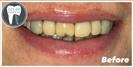 Porcelain Veneers - Fulop Clinic