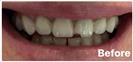 Porcelain Veneers - Fulop Clinic