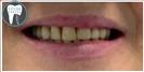 Porcelain Veneers - Fulop Clinic