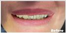 Porcelain Veneers - Fulop Clinic