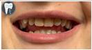 Porcelain Veneers - Fulop Clinic