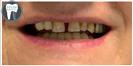 Porcelain Veneers - Fulop Clinic