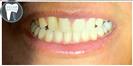 Porcelain Veneers - Fulop Clinic