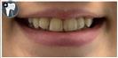 Porcelain Veneers - Fulop Clinic