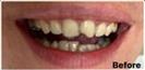 Porcelain Veneers - Fulop Clinic