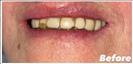 Porcelain Veneers - Fulop Clinic