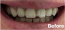 Porcelain Veneers - Fulop Clinic