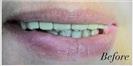 Porcelain Veneers - Fulop Clinic