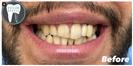 Porcelain Veneers - Fulop Clinic