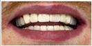 Tooth Bleaching - Fulop Clinic