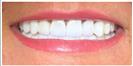 Tooth Bleaching - Fulop Clinic