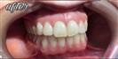 Tooth Bleaching - Fulop Clinic