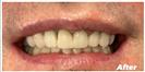 Tooth Bleaching - Fulop Clinic