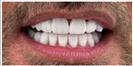 Tooth Bleaching - Fulop Clinic