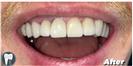 Tooth Bleaching - Fulop Clinic