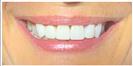 Tooth Bleaching - Fulop Clinic