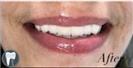 Tooth Bleaching - Fulop Clinic