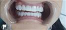 Tooth Bleaching - Fulop Clinic