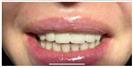 Tooth Bleaching - Fulop Clinic