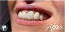 Tooth Bleaching - Fulop Clinic
