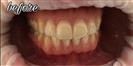 Tooth Bleaching - Fulop Clinic