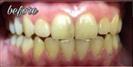 Tooth Bleaching - Fulop Clinic