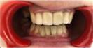 Tooth Bleaching - Fulop Clinic