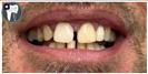 Tooth Bleaching - Fulop Clinic