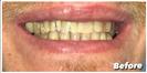 Tooth Bleaching - Fulop Clinic