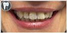 Tooth Bleaching - Fulop Clinic