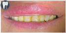 Tooth Bleaching - Fulop Clinic