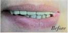 Tooth Bleaching - Fulop Clinic