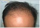 Hair Transplant - Hairmaxx