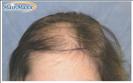 Hair Transplant - Hairmaxx