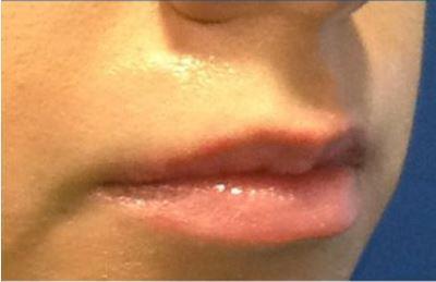 Dermal Fillers
