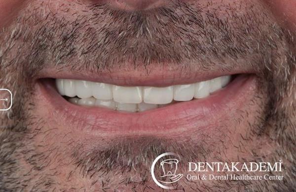 Tooth Extraction and Dental Implants: All-on-6 Implants & All-on-4 Implants