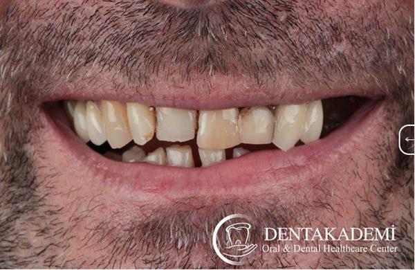 Tooth Extraction and Dental Implants: All-on-6 Implants & All-on-4 Implants