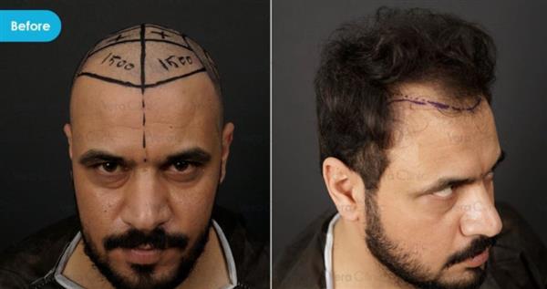 FUE Hair Transplant