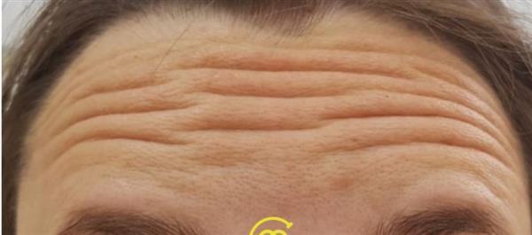 Botox