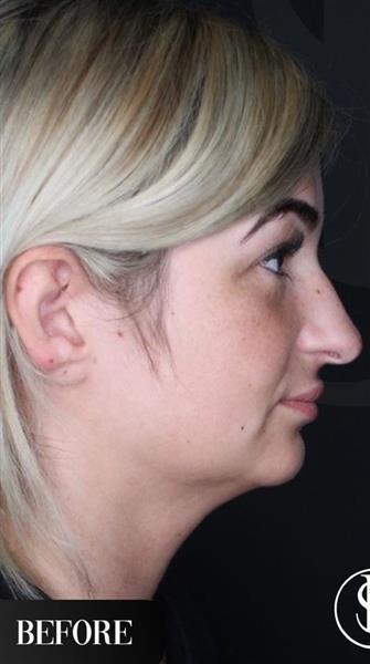 Double Chin - Vaser Liposuction - Ultrasonic Rhinoplasty