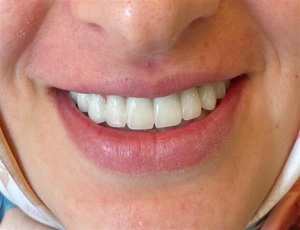 Porcelain Veneers