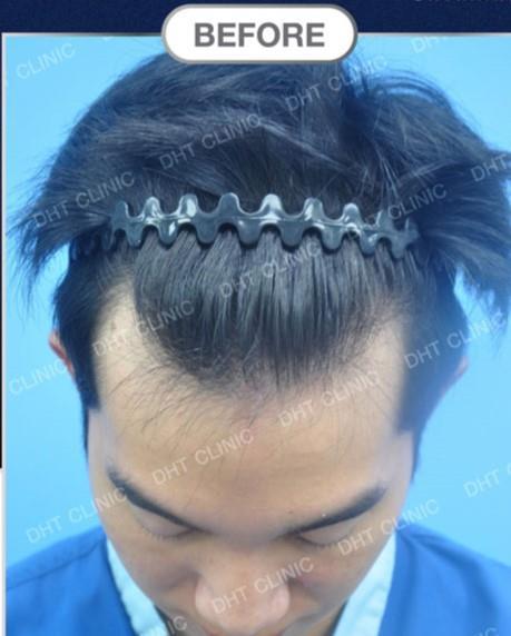 FUT Hair Transplant