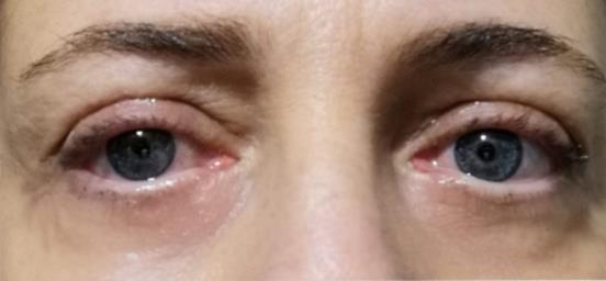Blepharoplasty (Eyelid Surgery)