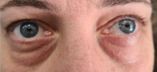 Blepharoplasty (Eyelid Surgery)