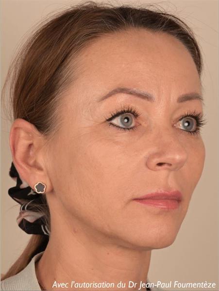 Zone treated: face, (cheekbones, jowls, nasolabial grooves, marionette lines)