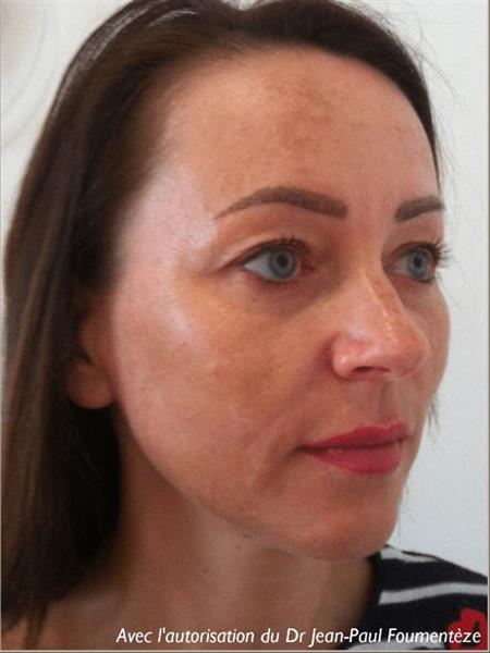 Zone treated: face, (cheekbones, jowls, nasolabial grooves, marionette lines)