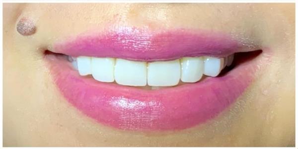 Porcelain Veneers