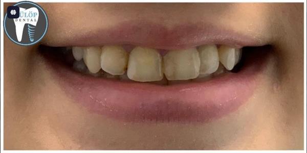 Porcelain Veneers