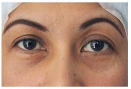 Lower Blepharoplasty