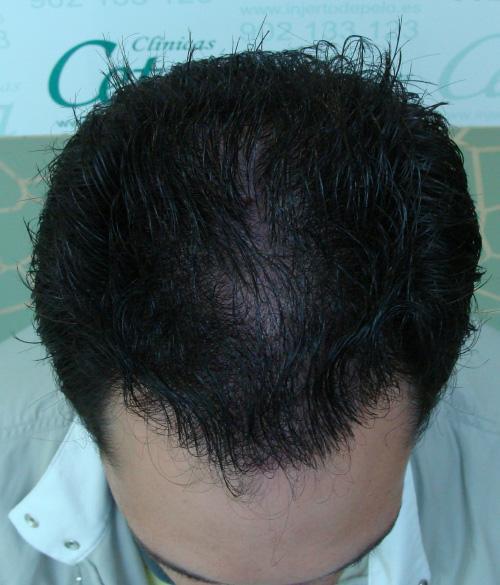FUE transplant - 2,000 grafts